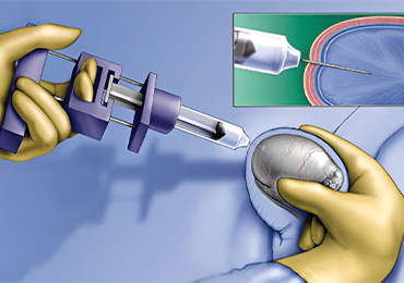 Best Pesa Treatment in Mudichur