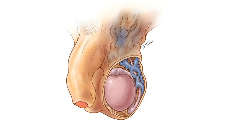 Varicocele Surgery in Mudichur